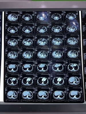 Equipamento médico Filtro de impressão térmica a laser de densidade azul de raios X