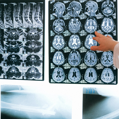 Jato de tinta Filme Seco Médico Azul Transparente Filme de Raios-X Azul Para Dispositivo Radiológico CT DR MRI