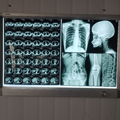 Resina A4 A3 Filme de Raios X Médicos para Gráficos de Radiologia