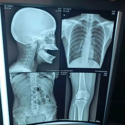 200±5μM Espessura Filme de raios-X Médico para Diagnóstico de Alta Densidade