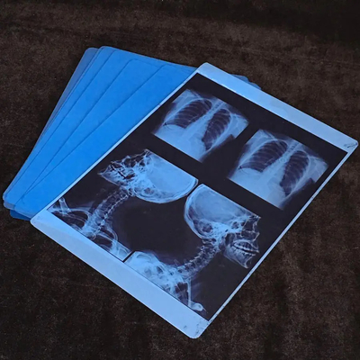 Impressões a jato de tinta para imagens médicas com filme médico de raios-X azul