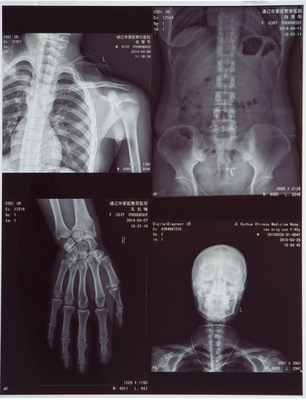 Película de jato de tinta azul de halogeneto de prata para imagens médicas