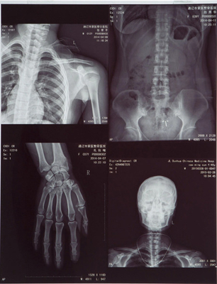 Filme de raios X Médicos de alta clareza FUJI DIHT 14*17in Laser Dry Imaging Film