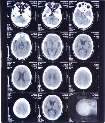 Filme de raios X Médicos de alta clareza FUJI DIHT 14*17in Laser Dry Imaging Film