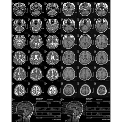 Filme de raios X médico de uso único ajustado à densidade automática