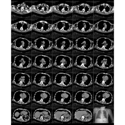 Filme laser radiográfico avançado de impressão a laser azul com processo de impressão térmica