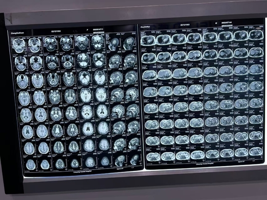 Película de raios X de densidade automática para equipamentos médicos