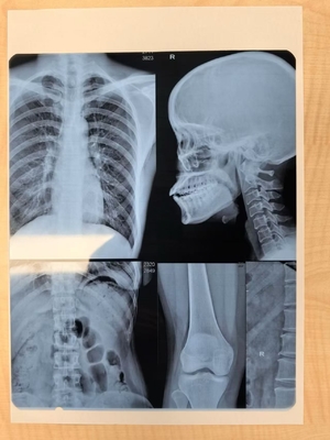 Ajuste automático de densidade de filme de raios-X a laser para imagem médica
