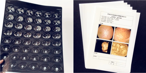 Produtos médicos Impressão a laser Filme branco opaco Filme médico de raios-X Imagem Impressão de filme Para impressora a jato de tinta Epson &amp; Canon