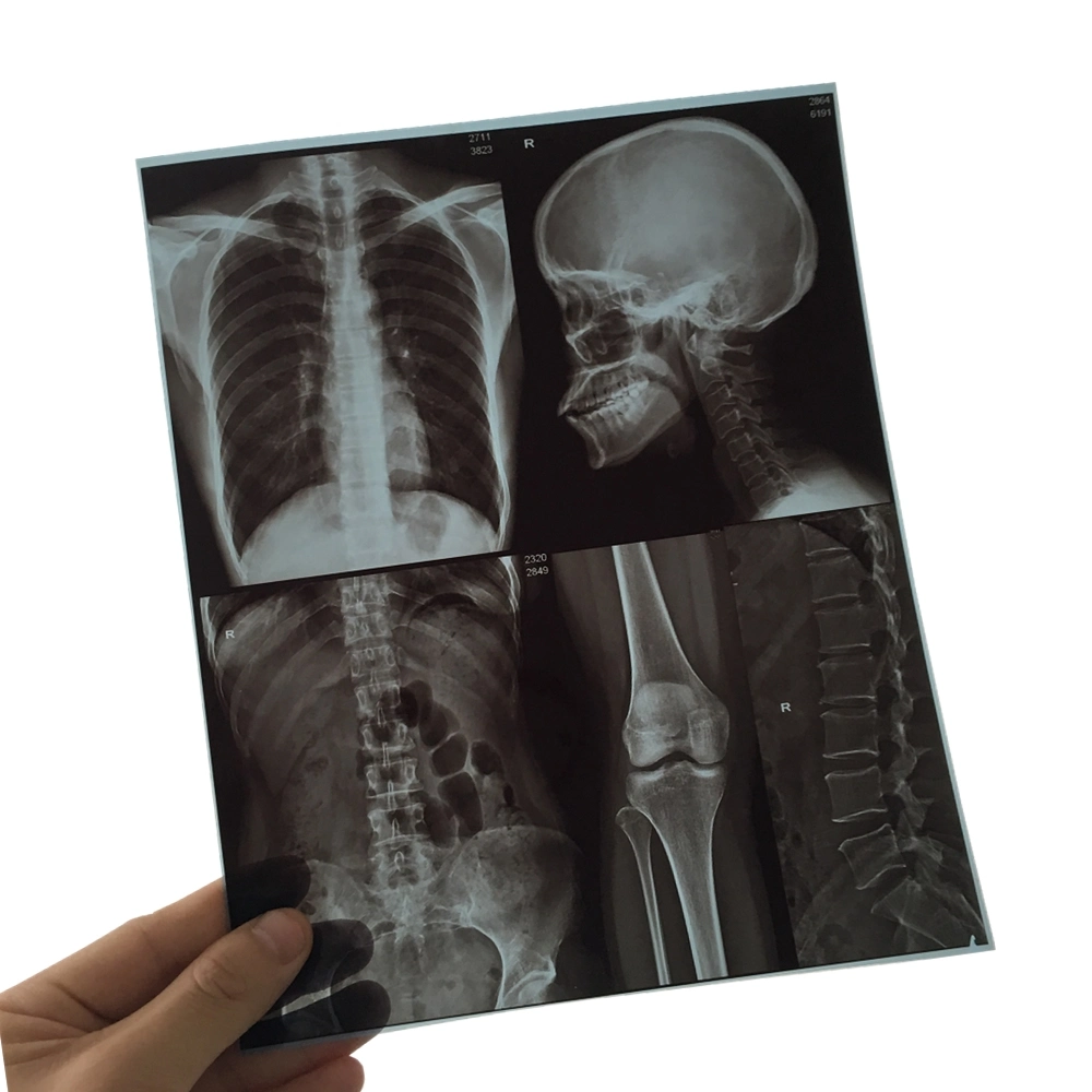 11X14 Inch Medical X-ray Film/Analogue Medical Film/Dry Film